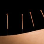 Иглоукалывание – эффективный способ похудеть — диеты